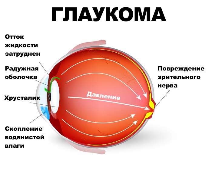Профилактика глаукомы